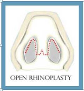 rhinoplasty1