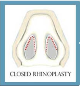 rhinoplasty3