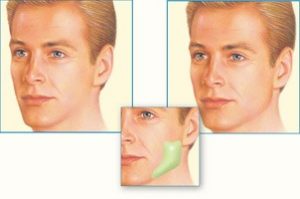 facial-implants2
