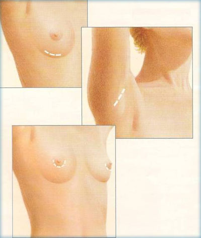 بزرگ کردن سینه