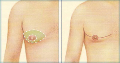 breast-reduction-2