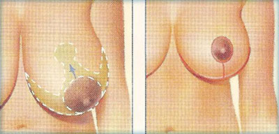 کوچک کردن سینه